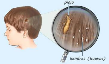 Piojos y liendres